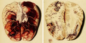 Figure 2. A: Plate V – Thrombosis of the superior sagittal sinus and feeding veins.  B: Plate VI – Petechial hemorrhages in cerebral venous thrombosis