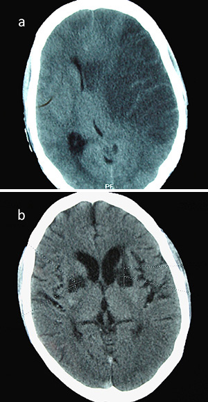 Figure. HIV-associated stroke: (a) middle cerebral artery infarct; 25-year-old HIV-infected male, CD4+ cell count = 42 cells/mm3; (b) bilateral basal ganglia infarcts; 25-year-old HIV-infected female, unknown CD4+ cell count.