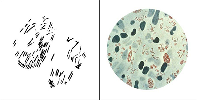 Figure 4. Left: Hansen's drawing (1880) of “brown elements colored with methyl violet, from a tubercle treated with osmic acid.” From Hansen (1880). Right: A photomicrograph of Mycobacterium Leprae (small red rods), taken from a leprosy skin lesion. Public domain. Courtesy of the U.S. Centers for Disease Control and Prevention, Public Health Image Library (PHIL) #2123. 
